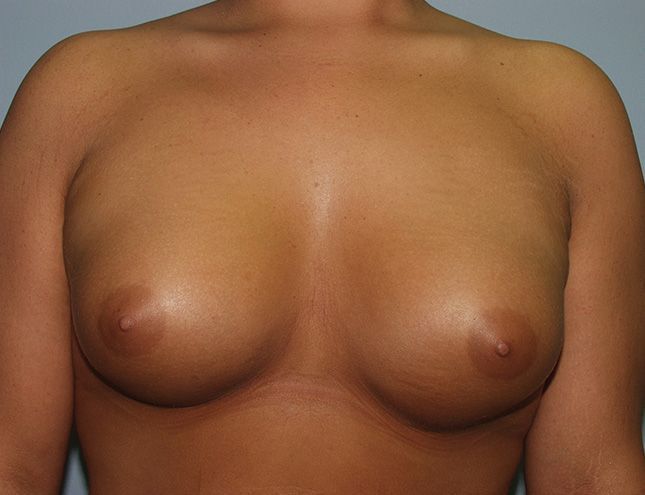 Breast Augmentation