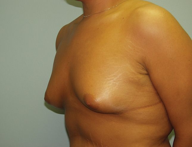 Breast Augmentation