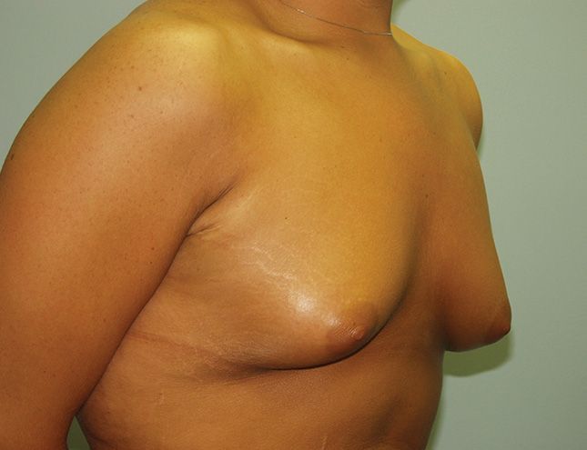 Breast Augmentation