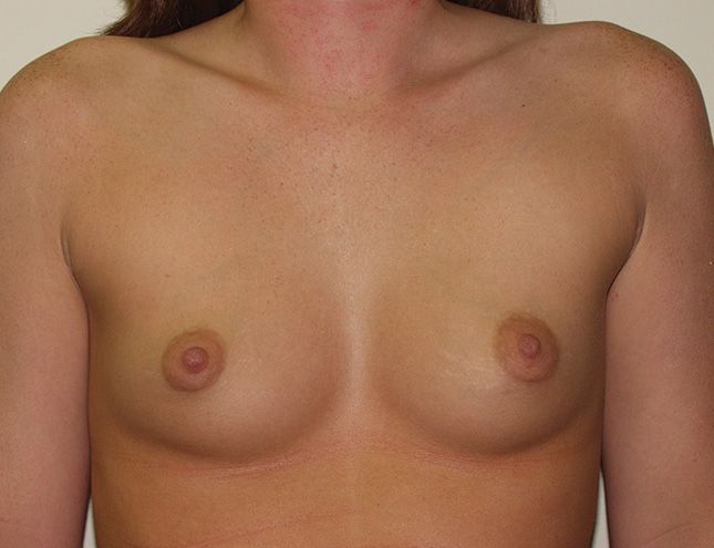 Breast Augmentation