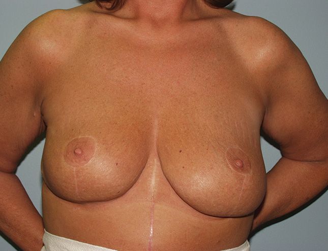 Breast Lift 