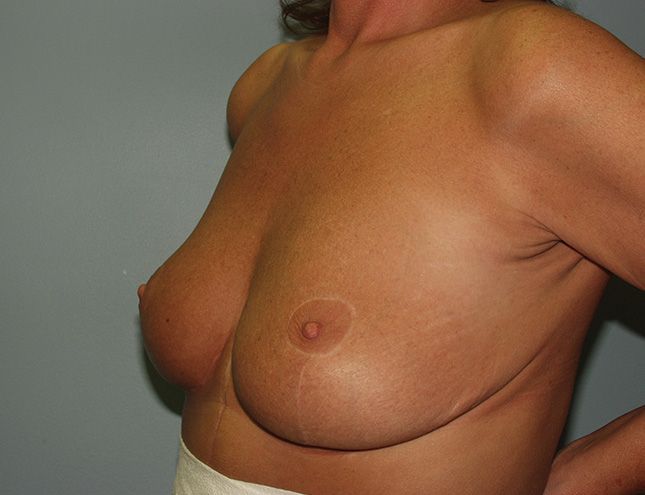 Breast Lift 