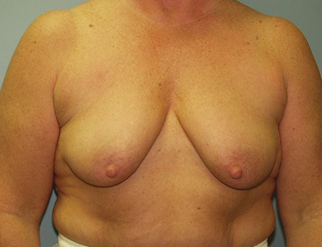 Breast Lift 