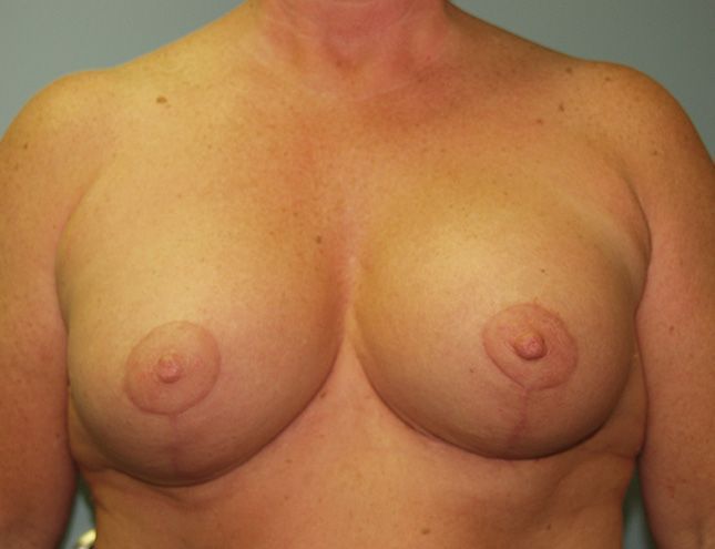 Breast Lift 