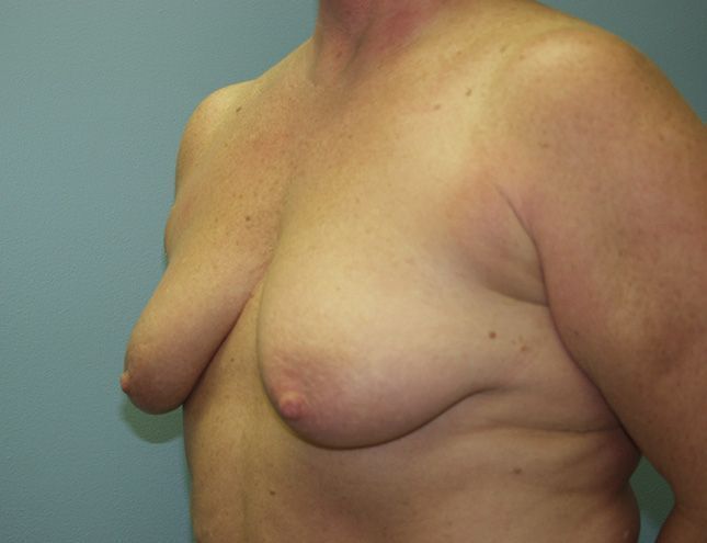 Breast Lift 