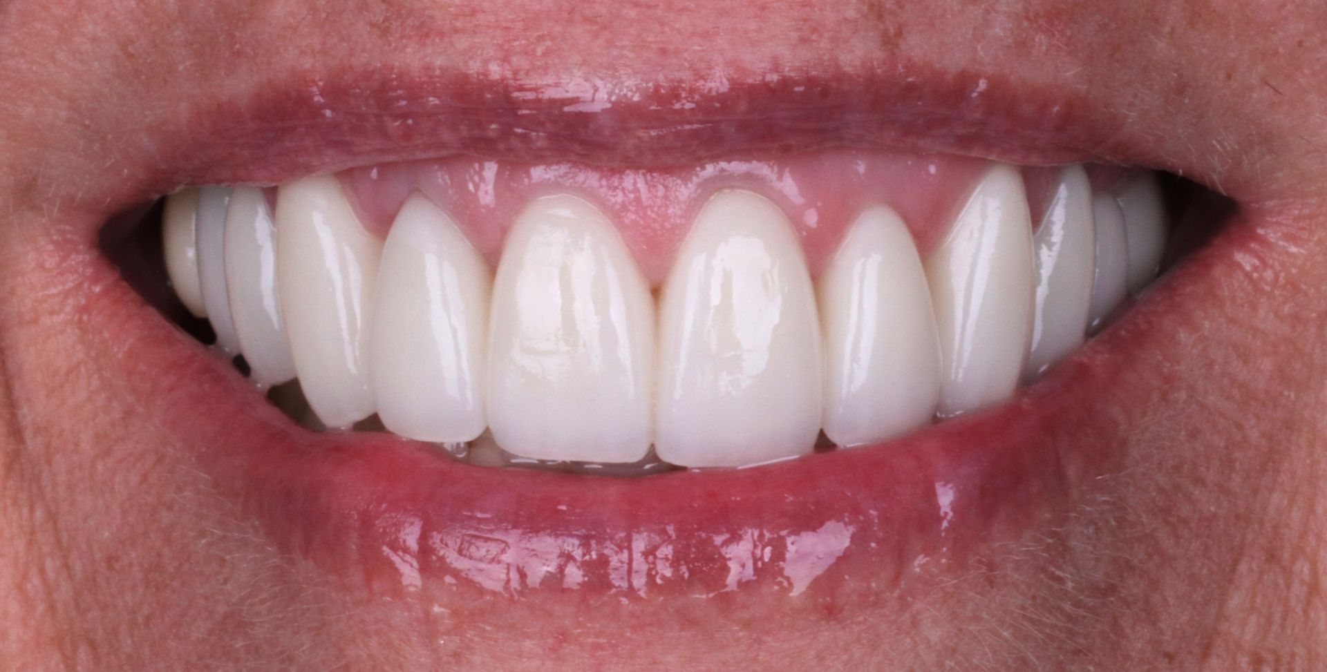 After: Close-up of a smiling mouth with white teeth and pink lips