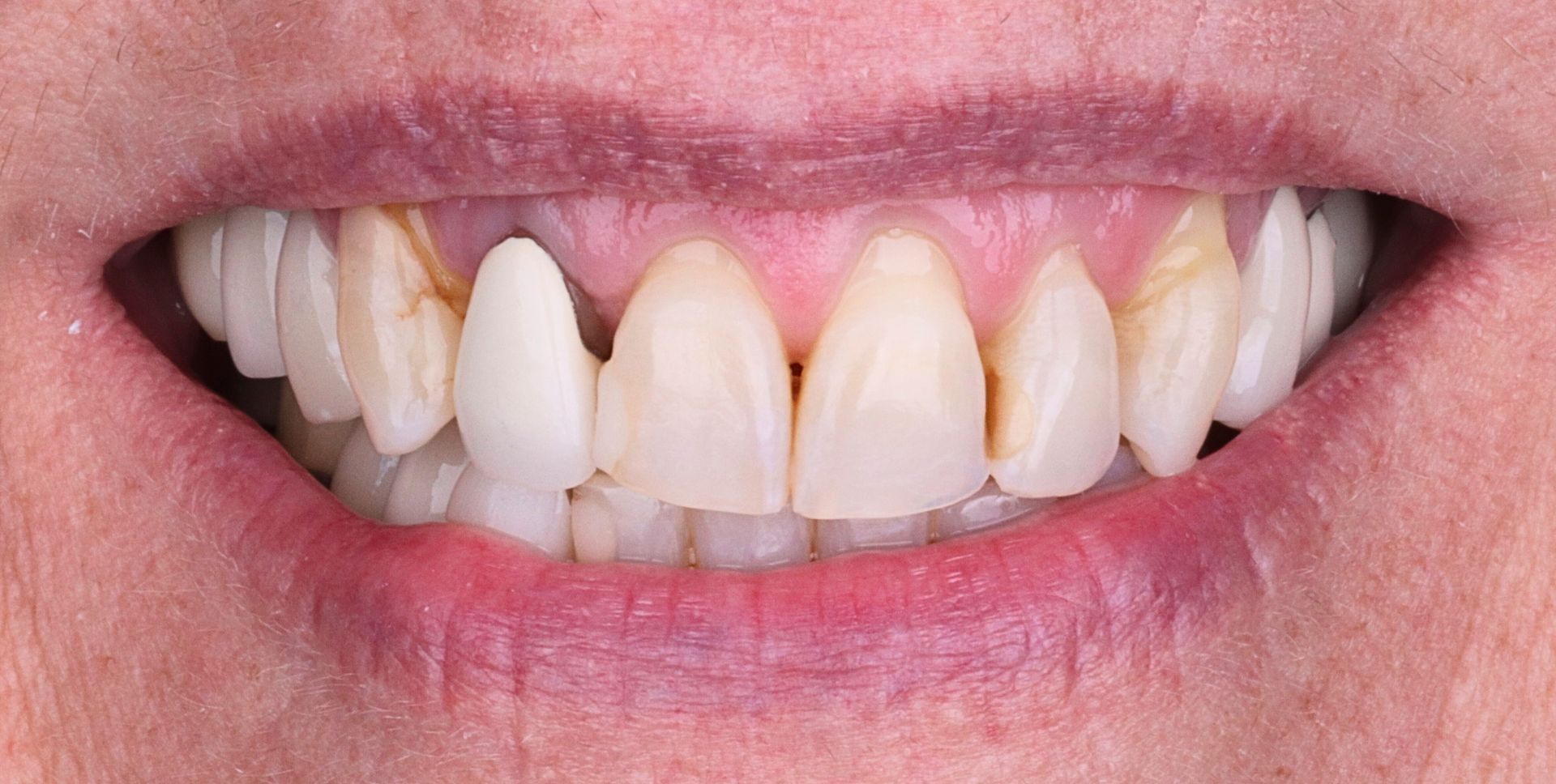 Before: Close-up of a mouth with visible upper teeth and a white front tooth
