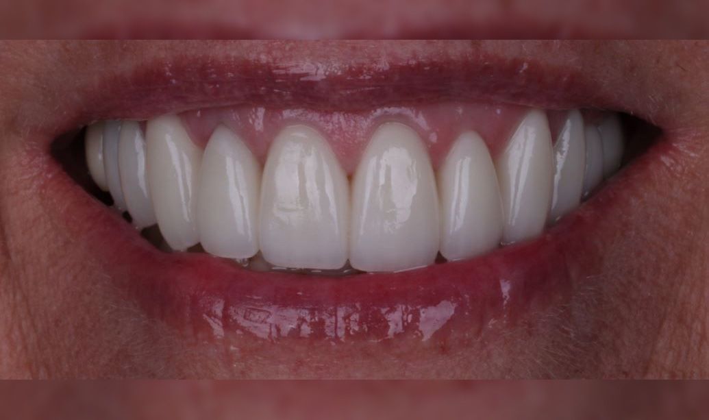 After: Close-up of a smiling mouth with white teeth and pink lips