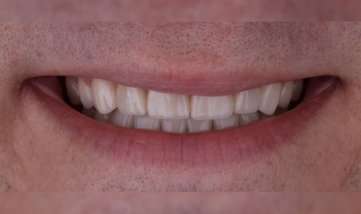 After: Close-up of a smiling mouth with visible teeth and pink lips