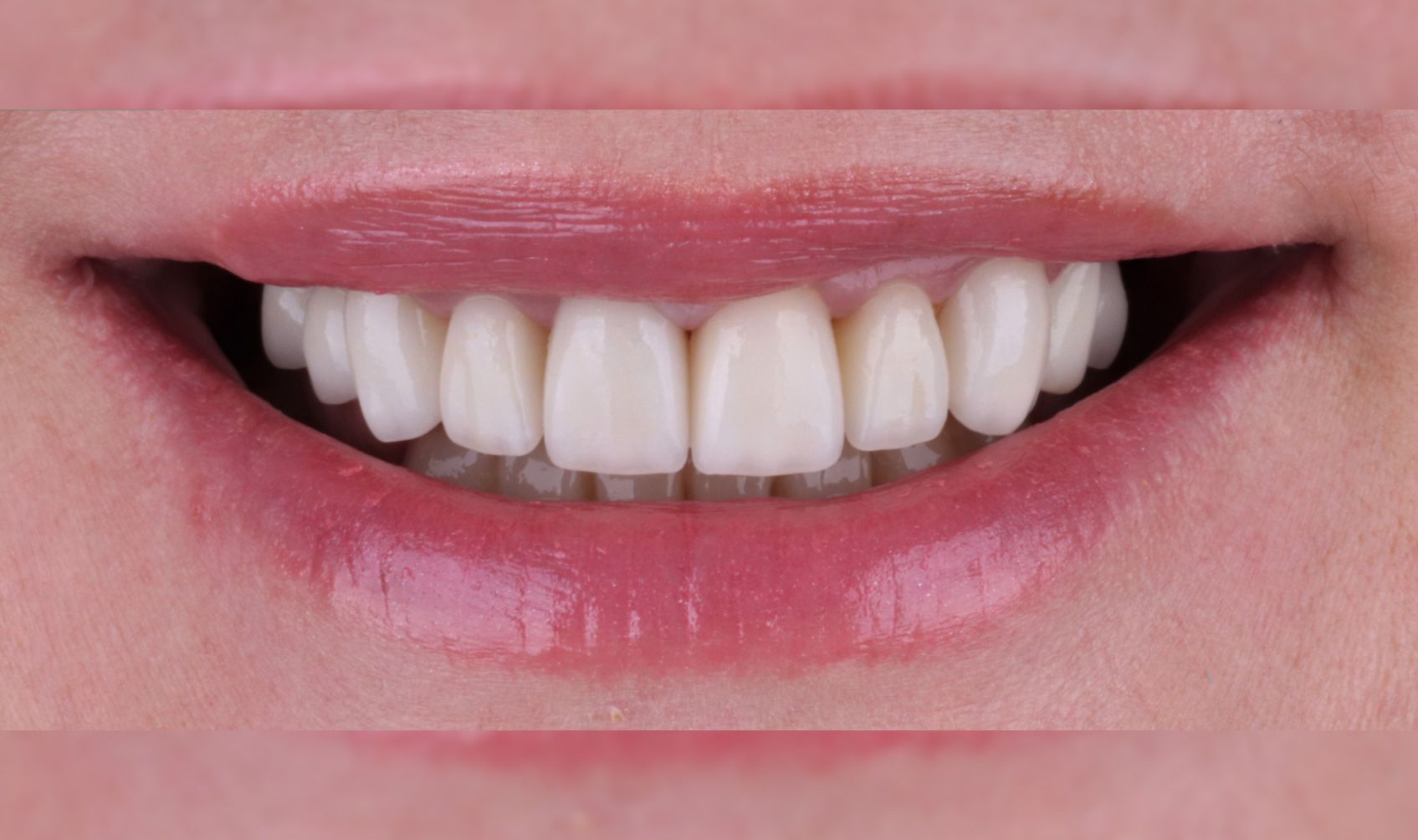 After: Close-up of a smiling mouth with white teeth and pink lips