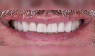 After: Close-up of a smiling mouth with white teeth and a pink upper lip.