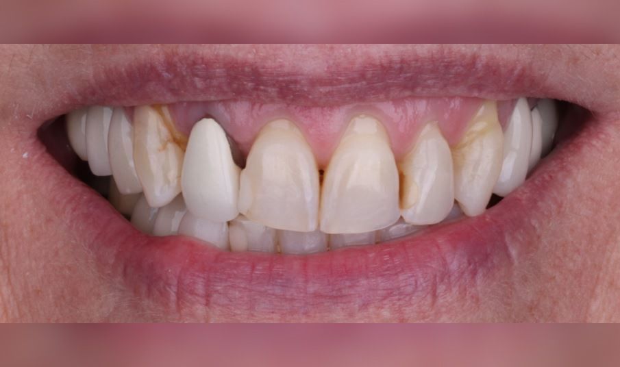 Before: Close-up of a mouth with visible upper teeth and a white front tooth