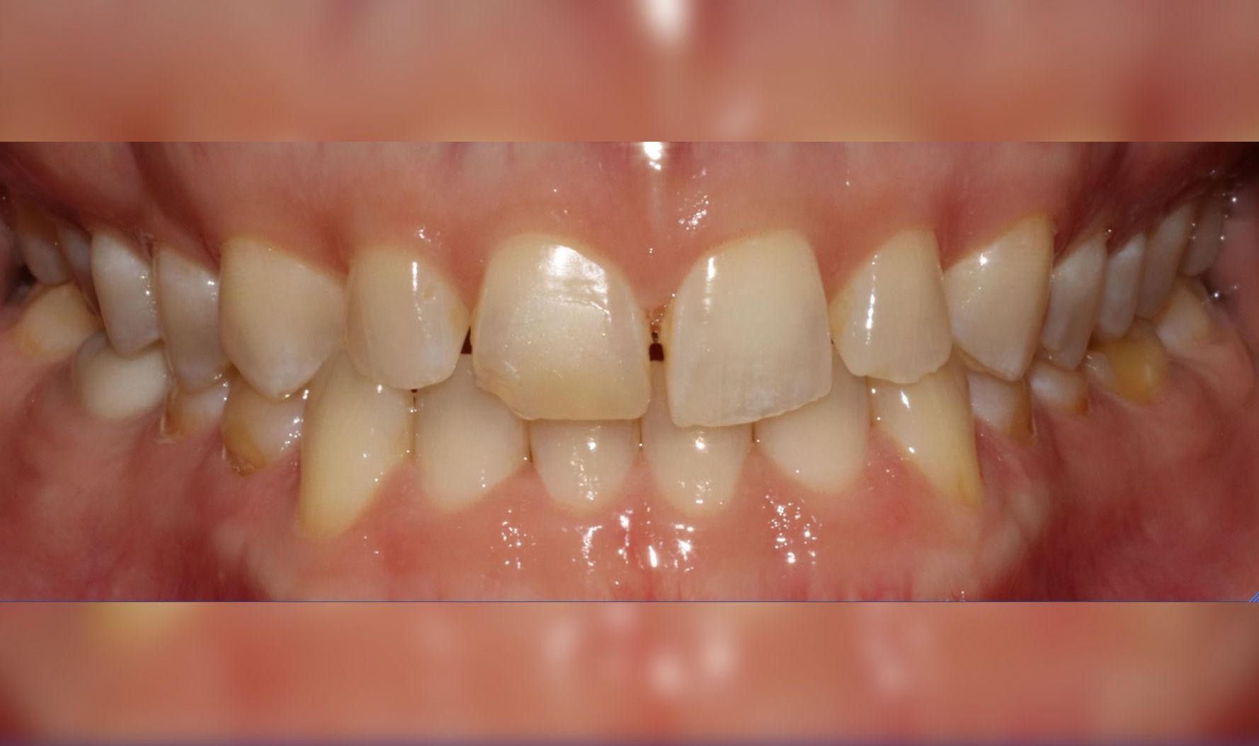 Before: Close-up of teeth and gums showing crooked front teeth and a slight gap
