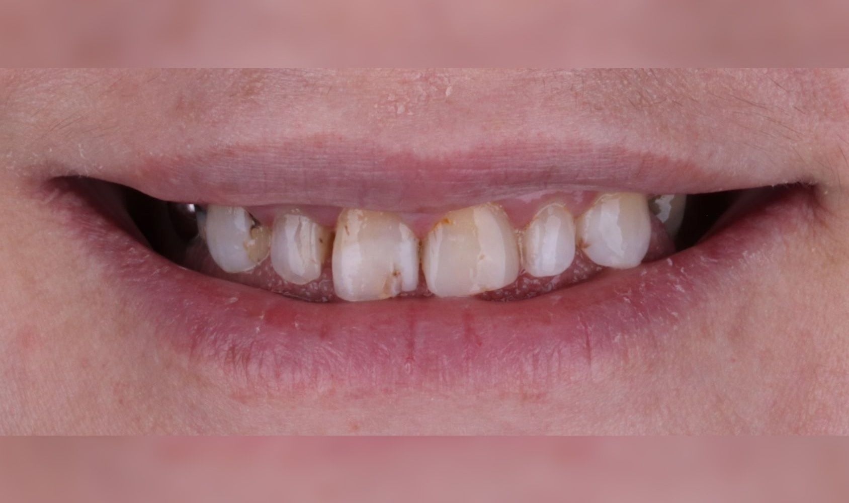 Before: Close-up of a smiling mouth with crooked, uneven teeth and a small gap