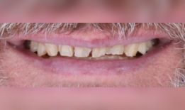 Before: Close-up of a smiling mouth showing uneven teeth and light facial hair.