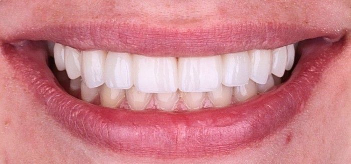 After: Close-up of a smiling mouth with white teeth and a pink upper lip.