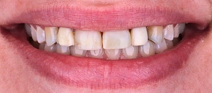 Before: Close-up of a smiling mouth showing uneven teeth and light facial hair.