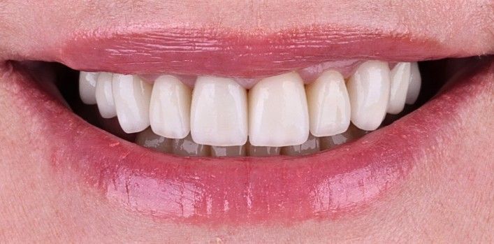 After: Close-up of a smiling mouth with white teeth and pink lips