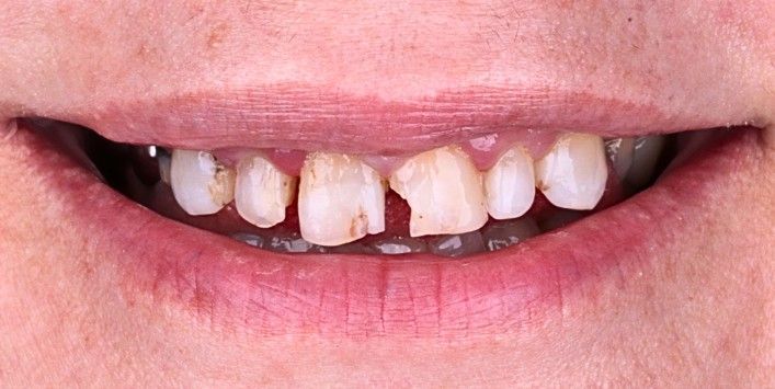 Before: Close-up of a smiling mouth with crooked, uneven teeth and a small gap