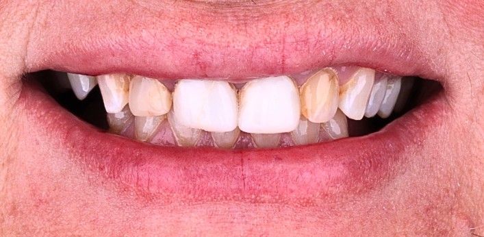 Before: Close-up of teeth and gums showing crooked front teeth and a slight gap