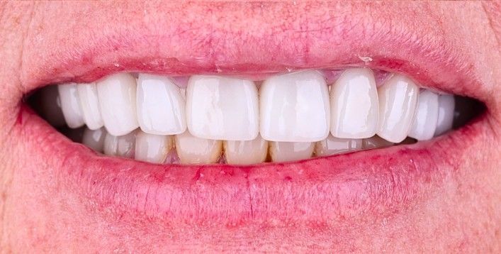 After: Close-up of a smiling mouth with visible teeth and pink lips