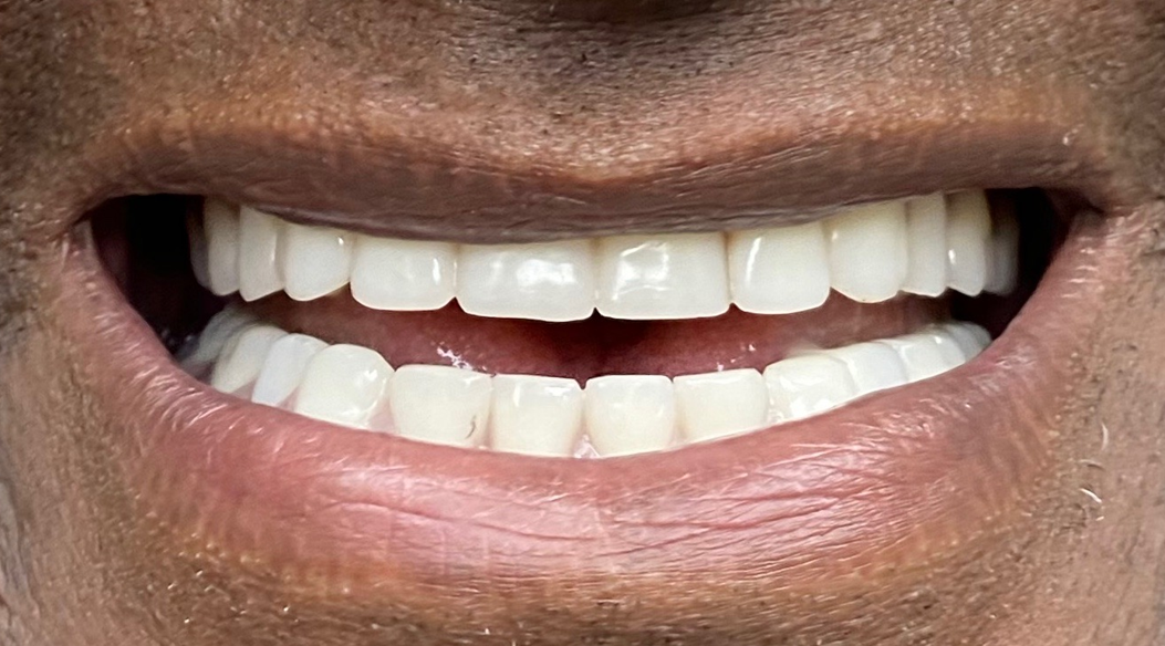 After Implant Dentistry