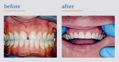 Before and after dental care