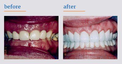 Before and after dental care