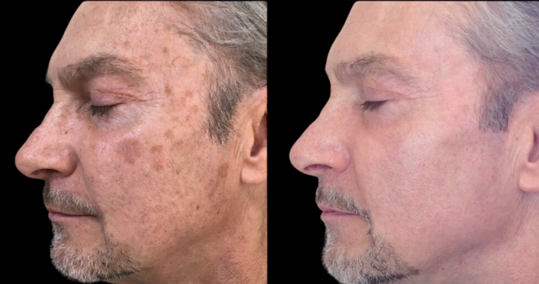 A before and after photo of a man's face.