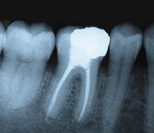 Teeth x-ray result