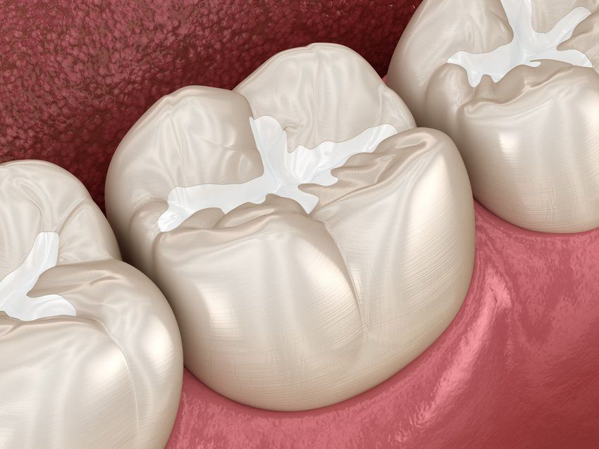 Molar dental fillings