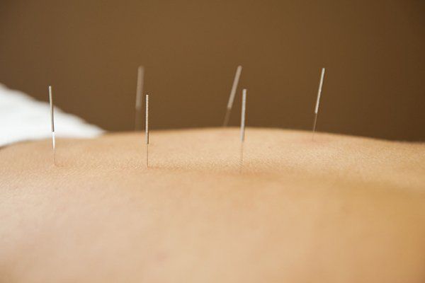 Acupuncture treatment