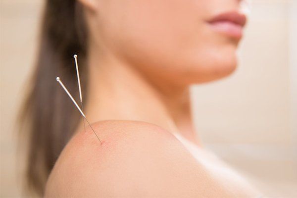 Woman having dry needling treatment