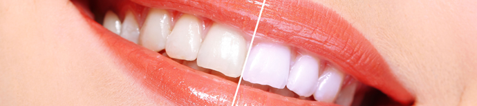 Teeth Whitening Process