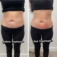 EMS before and after