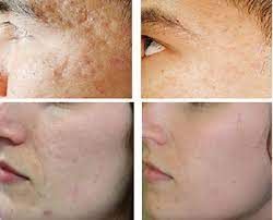 microneedling before and after