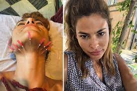 mono thread lift before and after