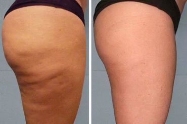 cellulite reduction