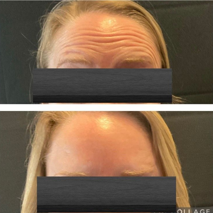 Before and after photos of a woman's forehead. Wrinkles reduced after cosmetic treatment.