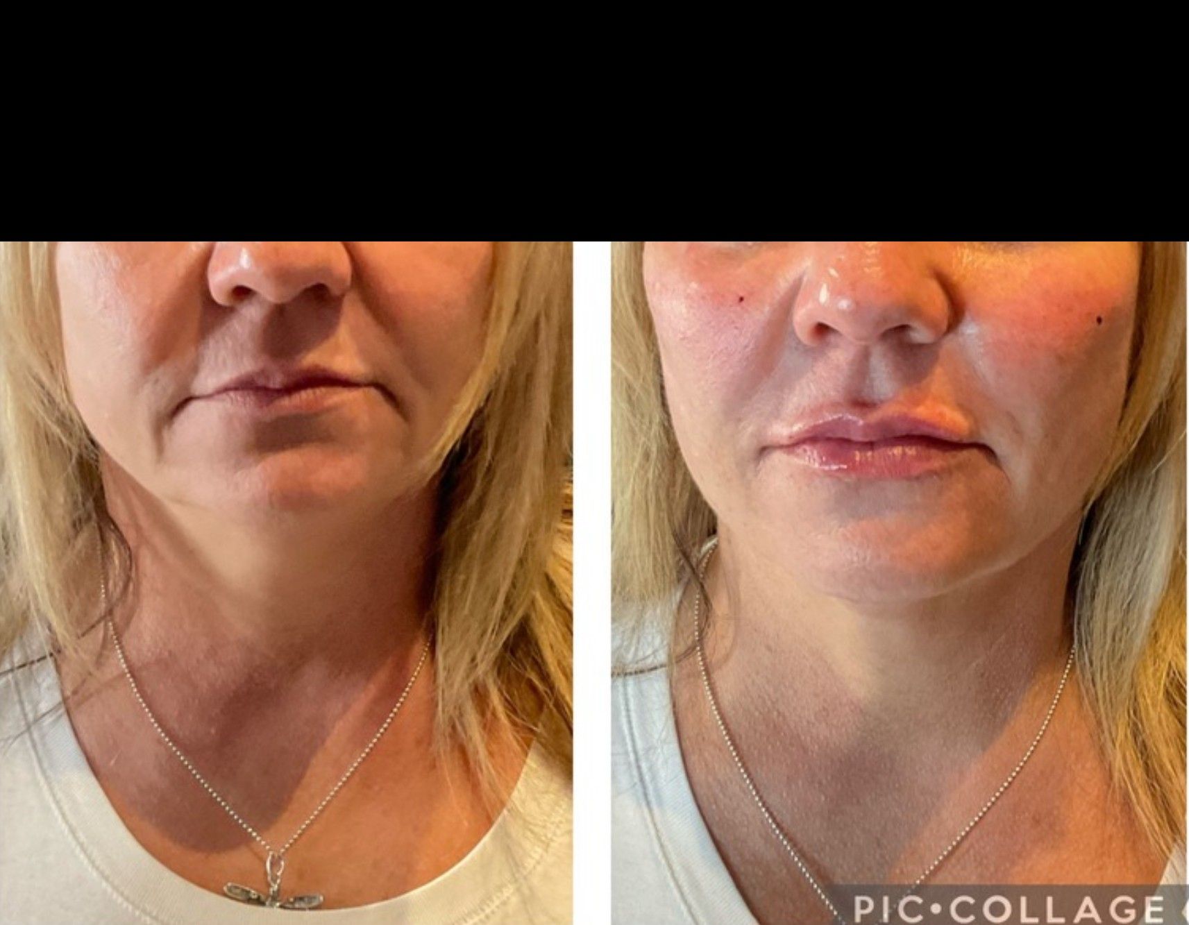 Side-by-side photo of a woman's face and neck. Before and after cosmetic injections, showing reduced wrinkles and fuller lips.