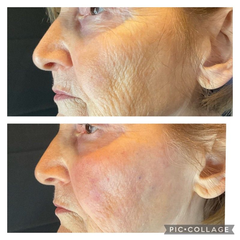 Before and after photos of a woman's face, showing reduction of wrinkles. Top photo shows wrinkles, bottom shows smoother skin.