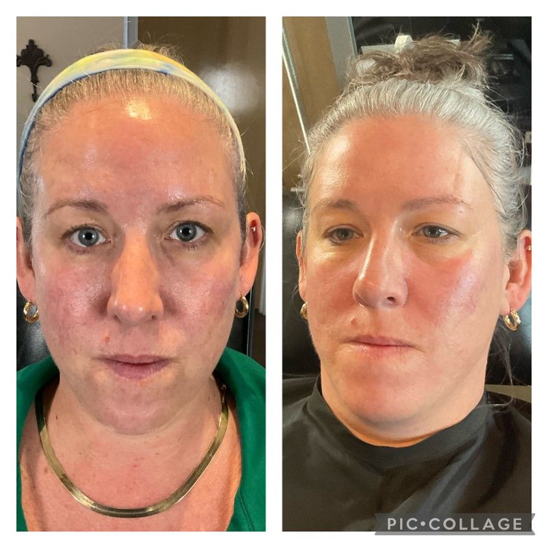 Side-by-side facial comparison: Before, woman with pink skin and headband; After, smoother skin and no headband.