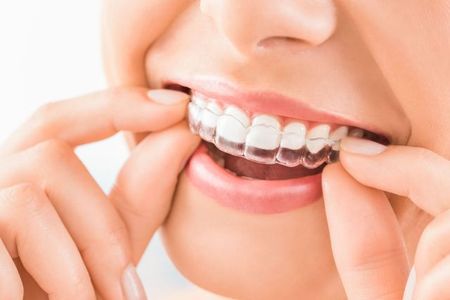 A woman is wearing invisible braces on her teeth.