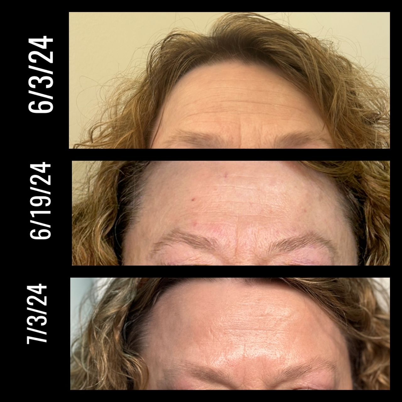 A woman 's forehead is shown before and after a treatment.