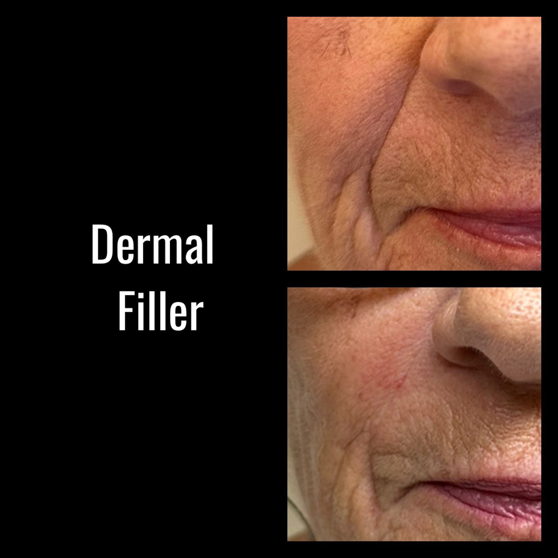 A before and after photo of a woman 's face with dermal filler.
