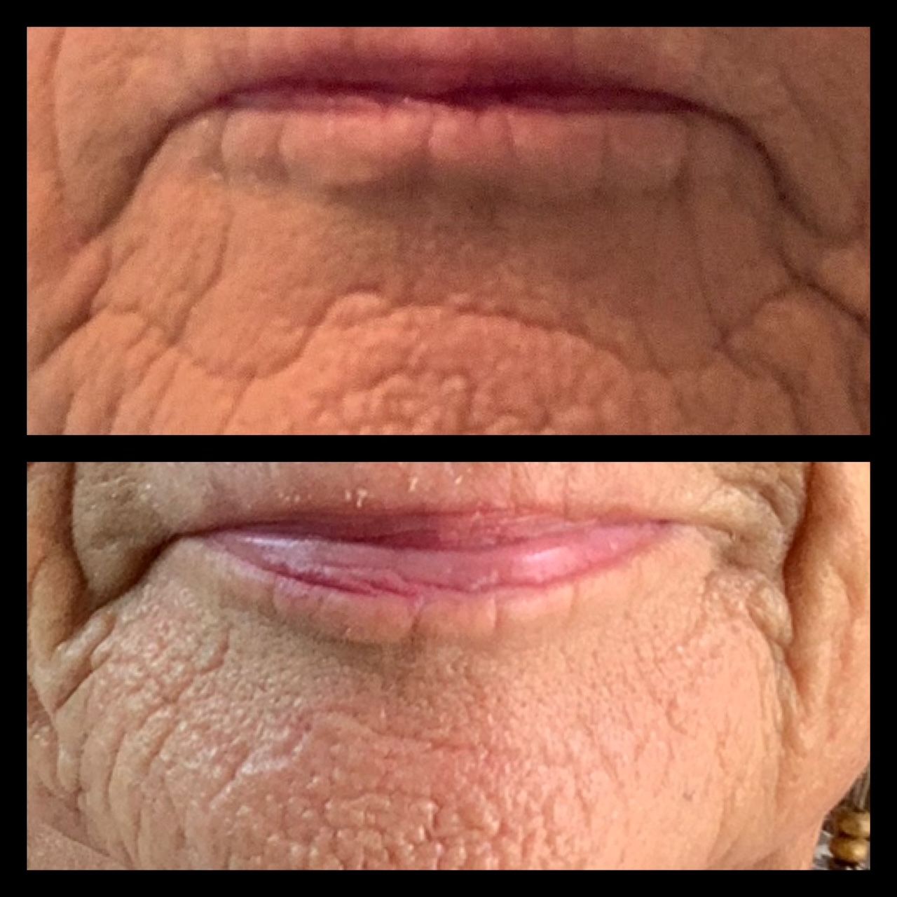 A before and after picture of a woman 's face with wrinkles.