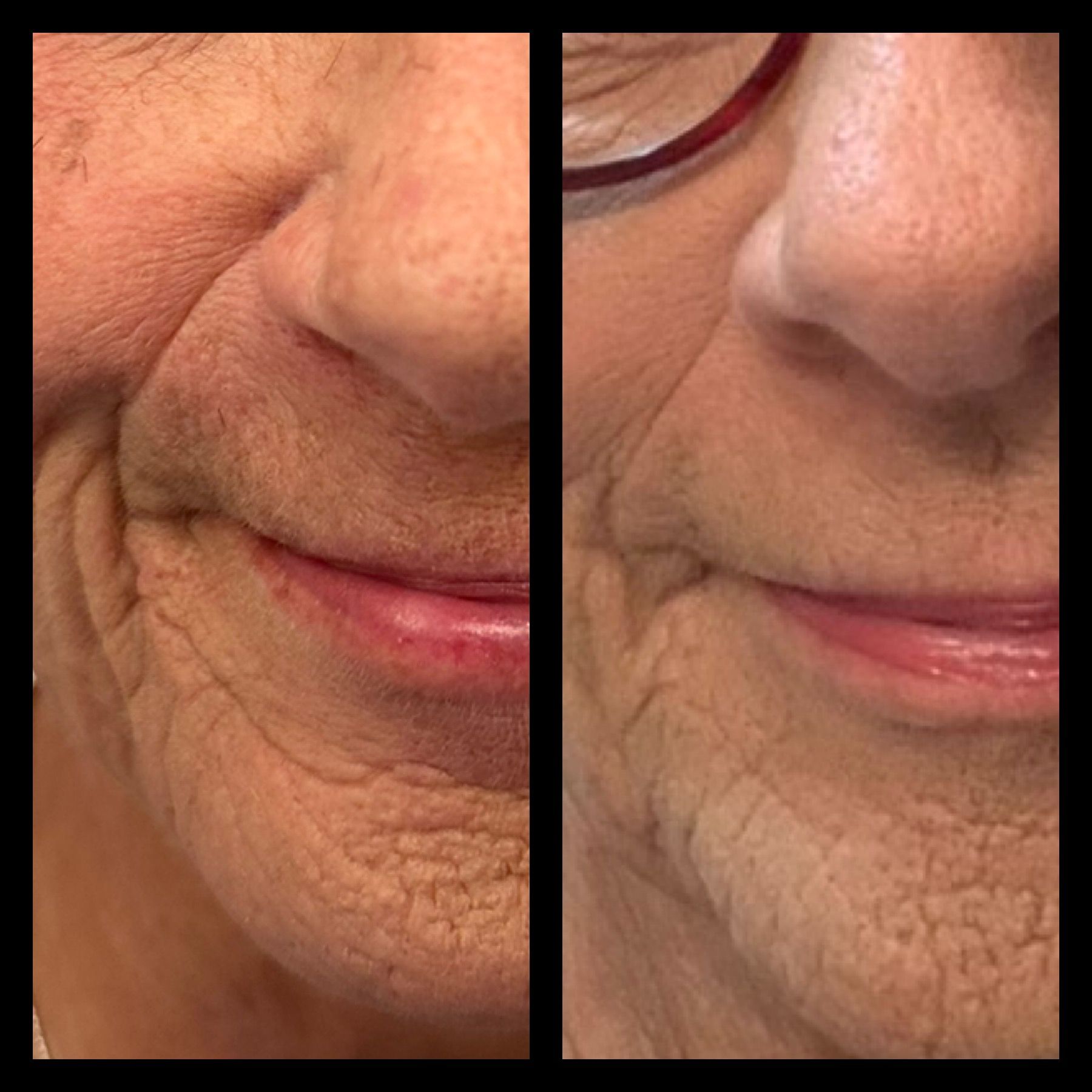 A before and after photo of a woman 's face with wrinkles.