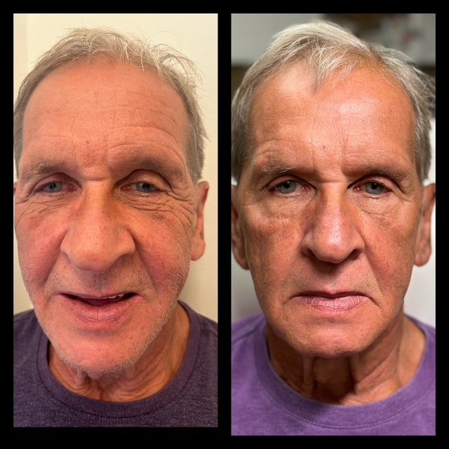 A before and after photo of an older man 's face