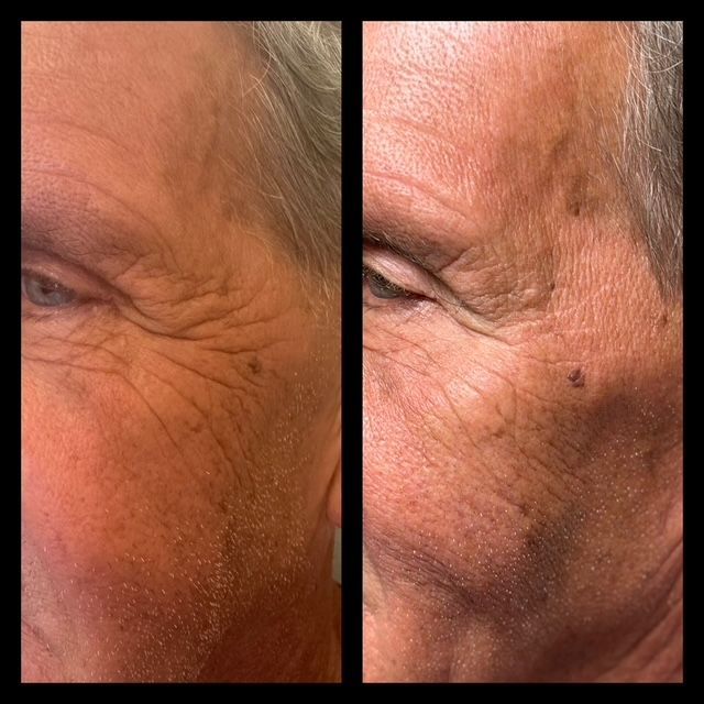 A before and after photo of a man 's face with wrinkles.