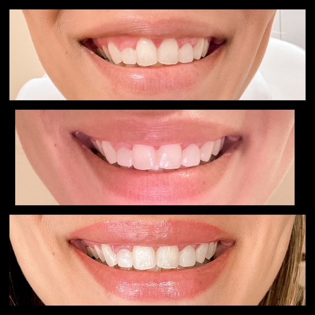 Three pictures of a woman 's teeth before and after whitening